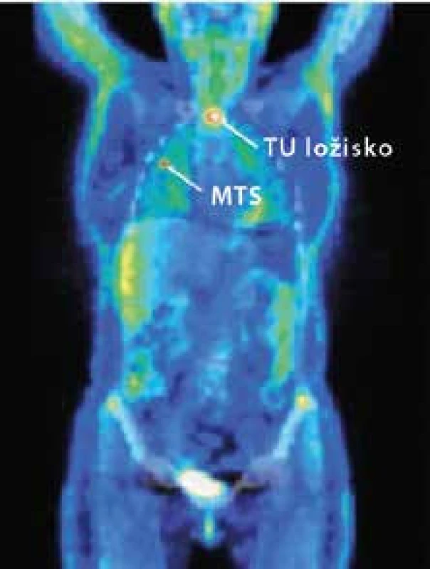Pozitrónová emisná tomografia (PET) s <sup>18</sup>fluorodeoxyglukózou