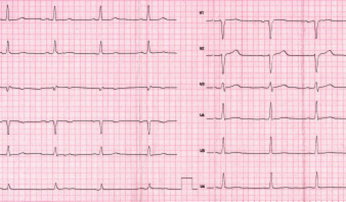 Po spomalení AV prevodu digitalisom a metoprololom, dochádza po 12 hodinách ku konverzii na sínusový rytmus a k ústupu repolarizačných zmien (klinický materiál III. internej kliniky LF UPJŠ a FGN L. Pasteura Košice).