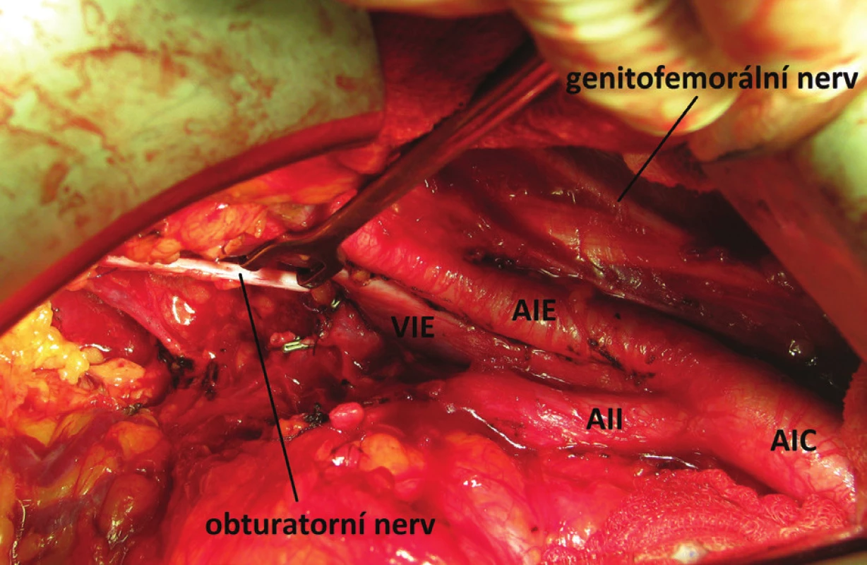 Peroperační snímek zobrazující pánevní lymfadenektomii
Fig. 2: Intraoperative picture illustrating pelvic lymph node dissection