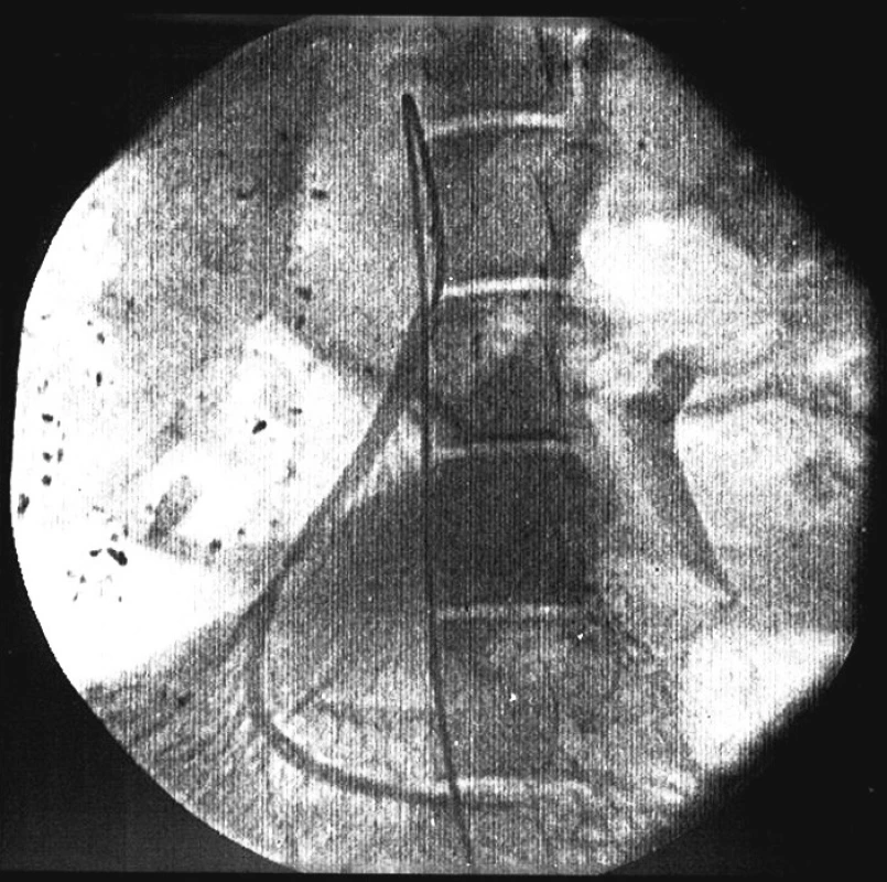 Periferní větve horní mezenterické tepny po embolizaci polyvinil-alkoholovými částicemi
Fig. 2. Peripheral branch of superior mesenteric artery after embolisation of polyvinyl alcohol particles
