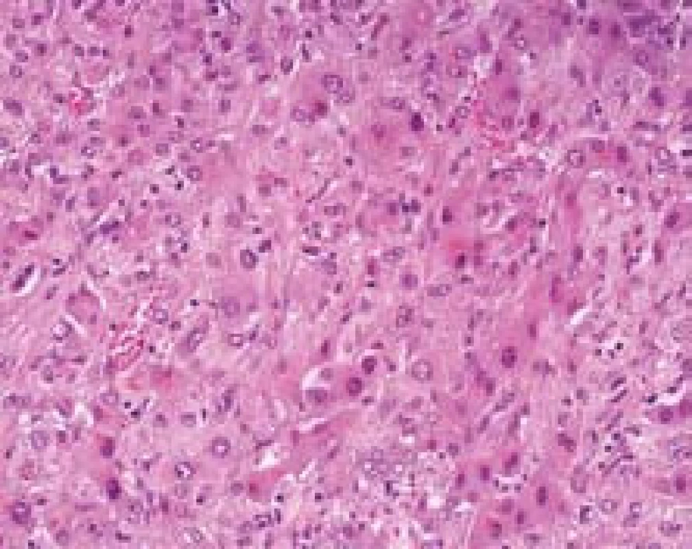 Epiteloidní hemangioendoteliom, nádorové buňky šířící se sinusy a reaktivní změny hepatocytů. Na úrovni HE je velmi obtížné rozpoznat, které elementy jsou vlastně nádorové. Barvení HE, zvětšení  objektiv 40×.
Fig. 5. Epithelioid hemangioendothelioma, tumor cells in the sinusoids and reactive changes of hepatocytes are shown. There is difficult to recognize the tumor cells in the H&amp;E stain. 