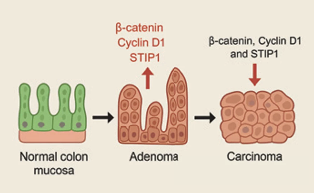 Schematic illustration of the pathophysiological roles of β-catenin, cyclin D1 , and STIP1 in colorectal tumorigenesis. The diagram summarizes their expression patterns in normal mucosa, adenomas, and colorectal carcinoma, highlighting interactions, nuclear translocation, and contributions to cell proliferation, tumor progression, and invasion. Obr. 2. Schematické znázornění patofyziologických rolí β-kateninu, cyklinu D1 a STIP1 v ko lorektální tumorigenezi. Diagram shrnuje jejich expresní vzorce v normální sliznici, adenomech a kolorektálním karcinomu, přičemž zdůrazňuje interakce, jadernou translokaci a příspěvky k buněčné proliferaci, progresi nádoru a invazi.