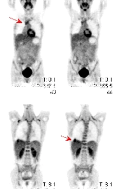 PET – ložiska hypermetabolizmu glukózy v mediastinu a nad pravou polovinou bránice u pacienta se synoviálním sarkomem.
