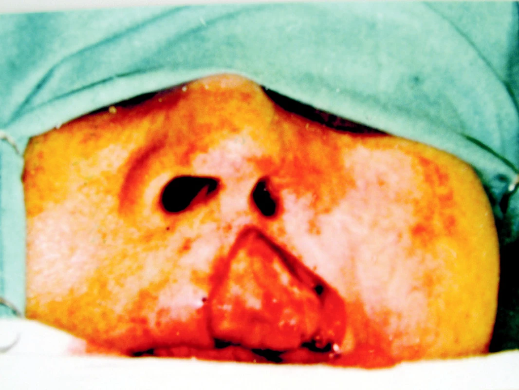 Stav po excizi basaliomu horního rtu se spontální epitelizací
Pic. 3. Excision of the upper lip basalioma with spontaneous epitalization – the postoperative condition