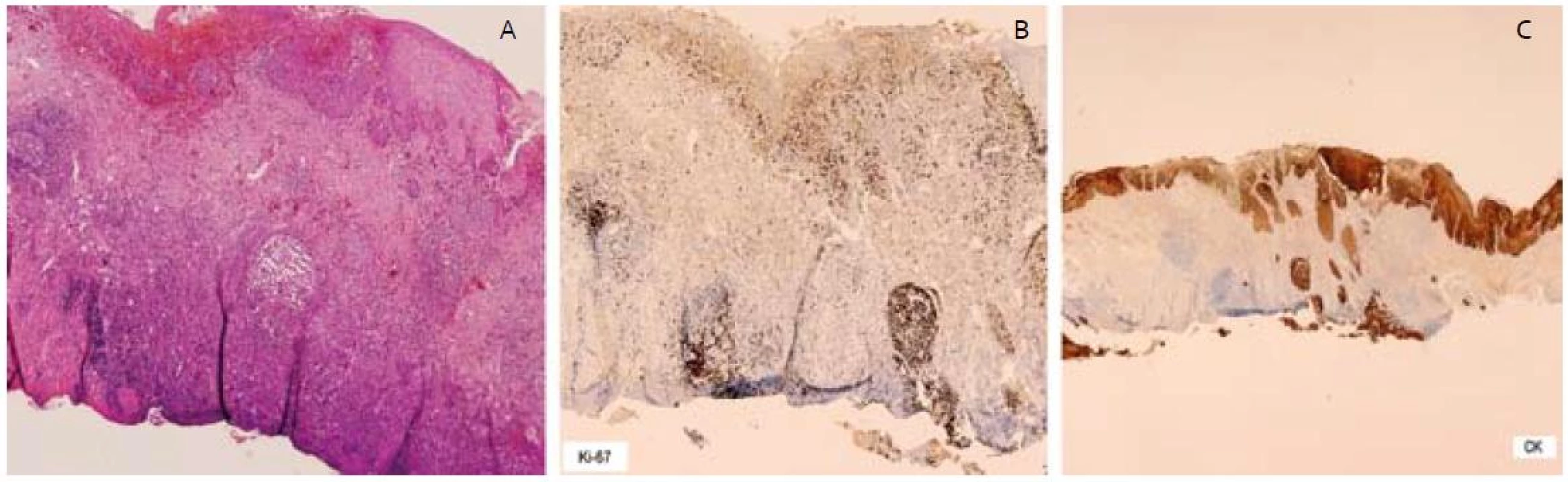 – invadujúce čapy ESCC, B – vysoká proliferačná aktivita Ki-67 v čapoch, C – imunohistochémia – cykeratín, čap dosahujúci spodinu resekátu.
Fig. 4. A – invasive squamous cell carcinoma of esophagus with infiltrating border, B – high proliferative activity of Ki-67, C – cytoceratin immunohistochemical staining, ESCC reached base of resection specimen.