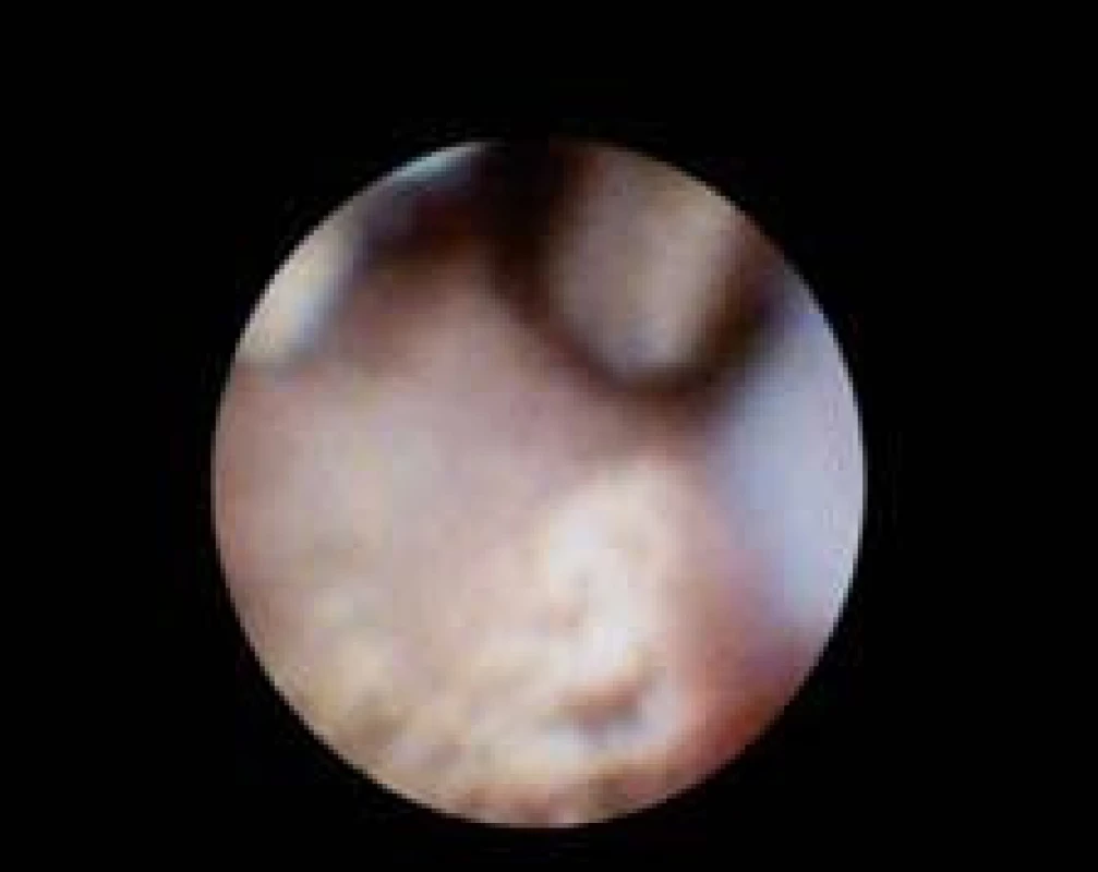 Konkrement v pankreatickém duktu (sonda pro EHL v zorném poli).
Fig. 7. Concrementum in the pancreatic duct (probe for EHL in the field of vision).