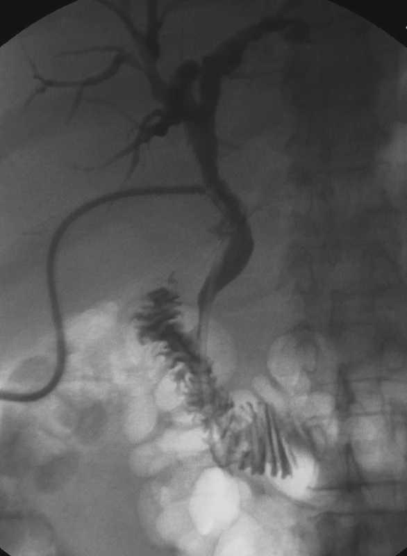 Pooperační nástřik T-drénu
Fig. 4. Post-operative visualisation of the T-drain