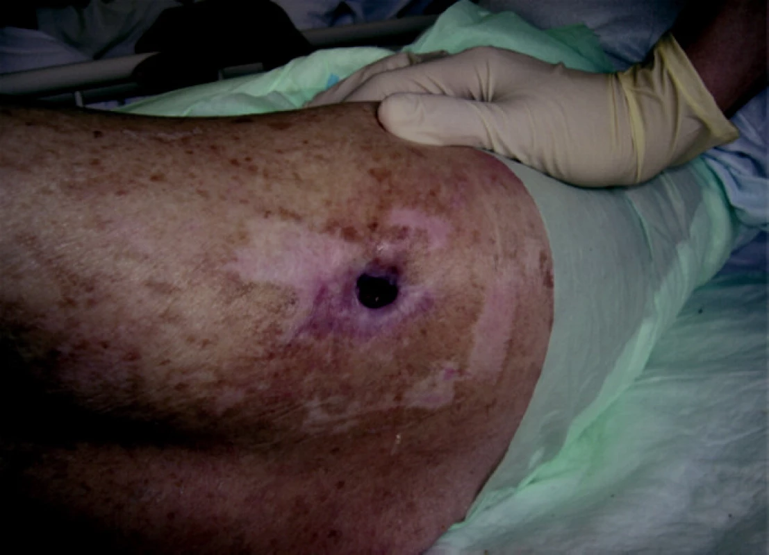 Efekt kontrolované výživy do PEG (75. den od příjmu)
