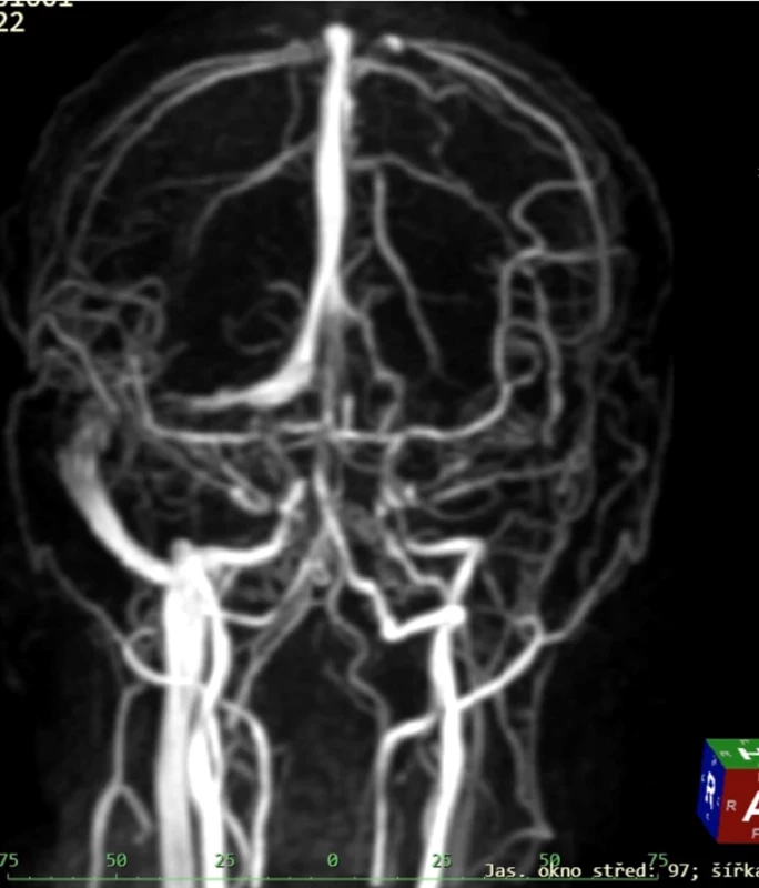 Obr. 5. MRAG potvrzující trombotický uzávěr sinus transversus a sinus sigmoideus na levé straně. .</br> Fig. 5. MR image confirming thrombosis of sinus transversus and sinus sigmoideus on the left side.