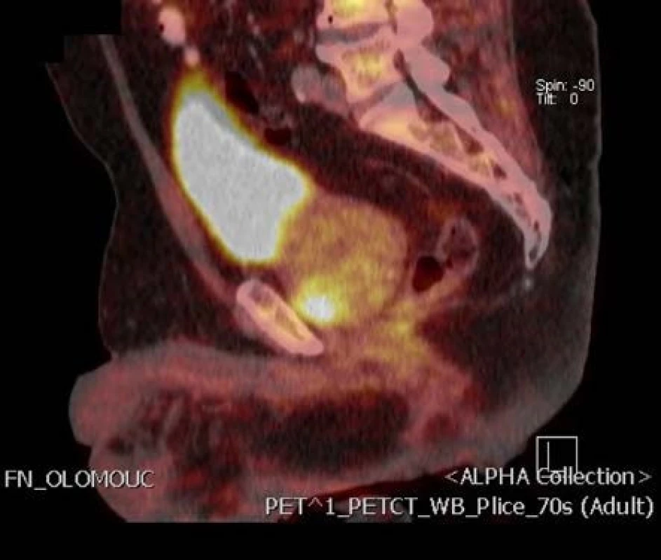 Ložisko tumoru v anteriorní zóně vlevo na 18-F-fluorocholin PET/CT podélný řez
Fig. 2. Focus of the tumor in anterior zone of the prostate on 18F-fluorocholine PET/CT longitudinal section