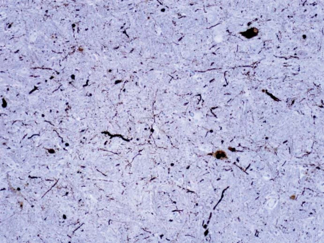 Dystrofické Lewyho neurity v oblongate vizualizované imunohistochemicky farbením alfa-synukleinom. Ojedinele sú patrnné i neuróny s cytoplazmatickými depozitami, tie majú v jednom mieste i charakter Lewyho teliesok.
Fig. 3. Dystrophic Lewy neurites in oblongata visualized by immunohistochemical staining for alpha-synuclein. Neurons with cytoplasmic deposits are rarely seen, these have a character of Lewy bodies in one location.