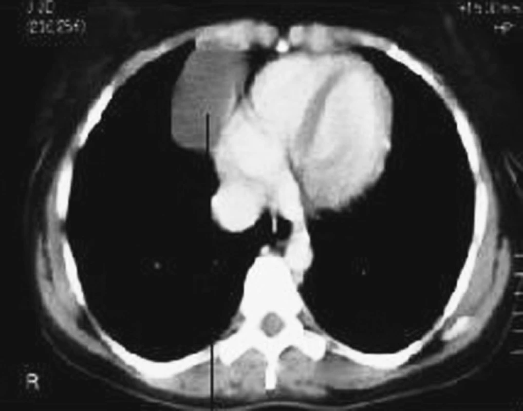 CT parakardiální cysty
Fig. 10. A CT scan of the paracardial cyst