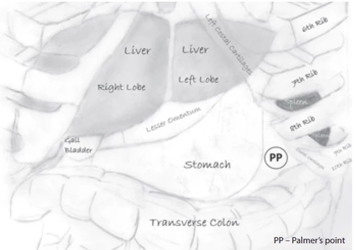 Schematic illustration of Palmer’s point and visceral organs in the upper abdomen. Obr. 2. Schematické znázornění Palmerova bodu a viscerálních orgánů v horní části břicha.