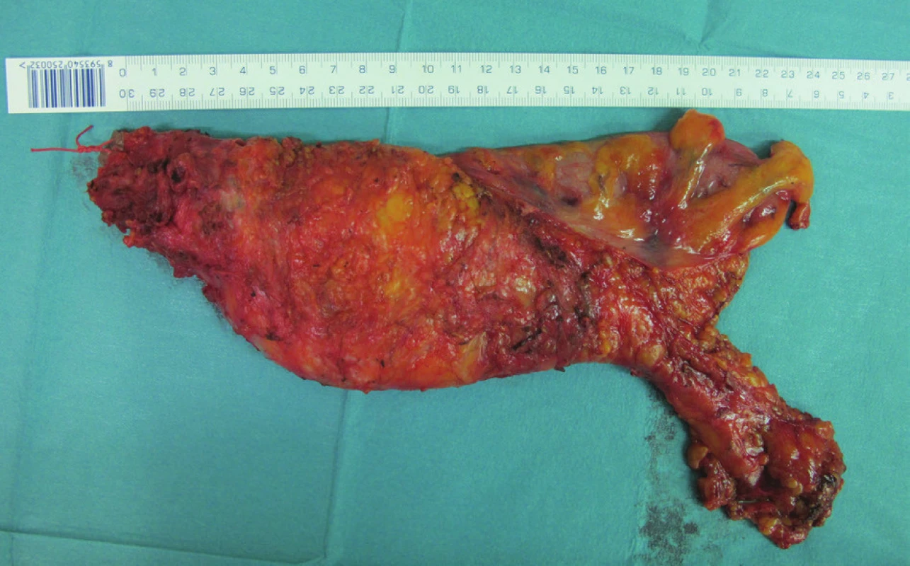 Kompletní TME (roboticky asistovaná exstirpace rekta) – fotografie resekátu
Fig. 2: Complete TME (robotic assisted APR) – photo of the resection specimen