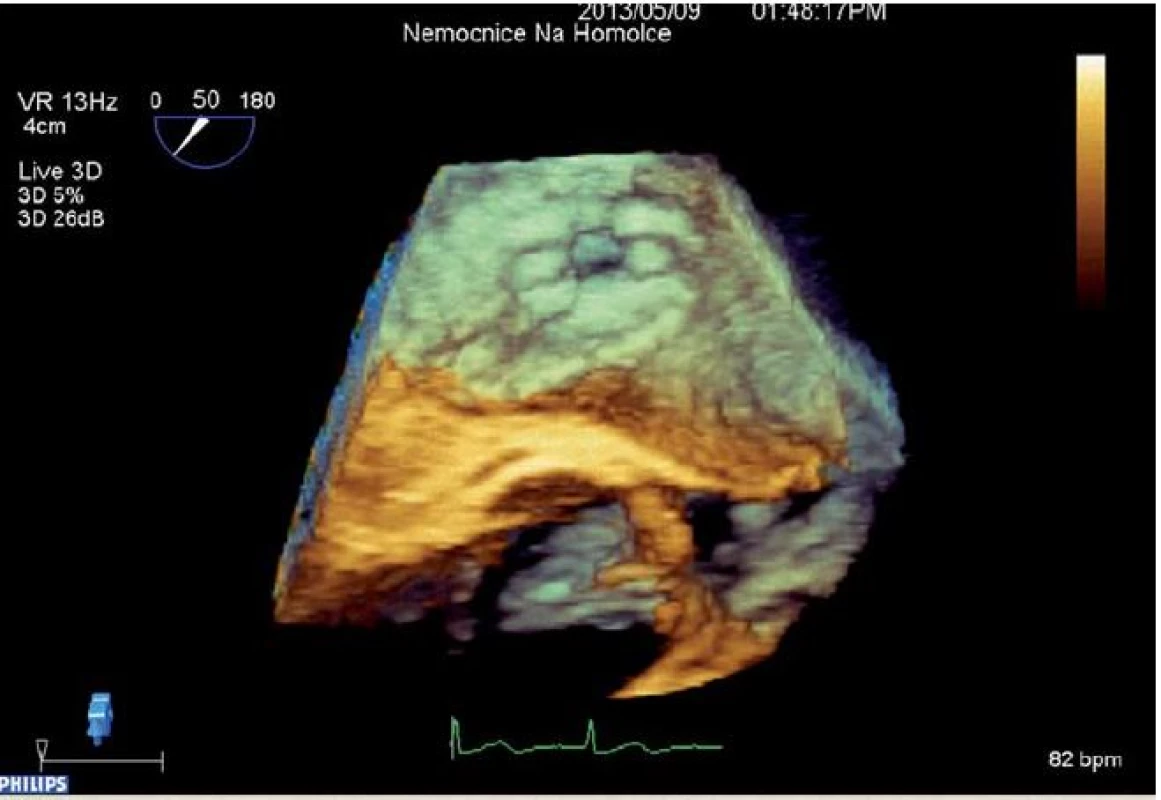 3D rekonstrukce IASD<sup>®</sup>.
