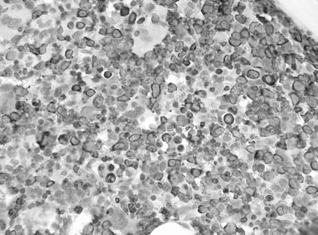 Prvé trepanobioptické vyšetrenie: prevaha myeloproliferácie so zadržanou maturáciou (dôkaz myeloperoxidázy, 60x).
Fig. 1. First trepanobioptic examination: prevailing myeloproliferation with subdued m