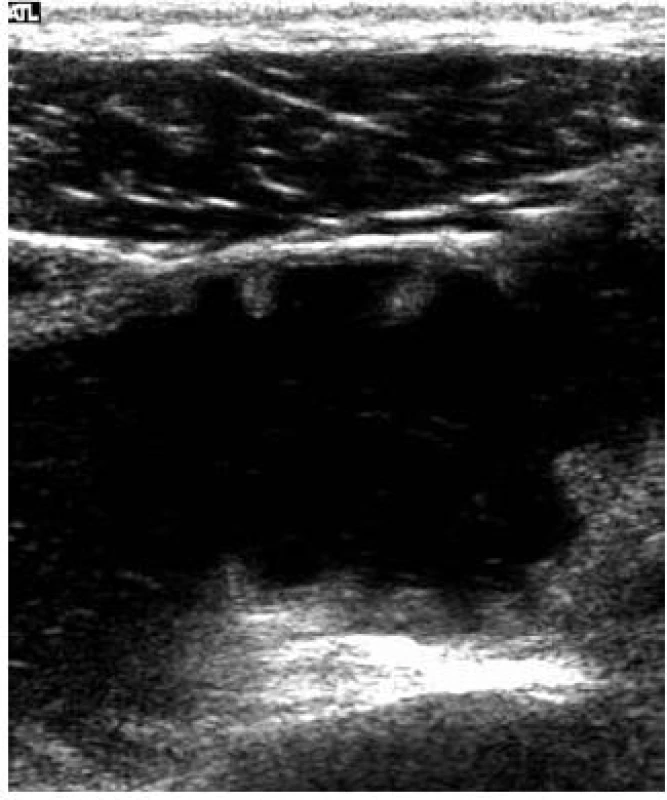 Celiakiální sprue – atrofie řas jejuna – „kolonizace jejuna“ – úbytek a ztluštění řas.
Fig. 5. Celiac sprue – villous atrophy – „jejunal colonization” – the loss and thickening of villi.