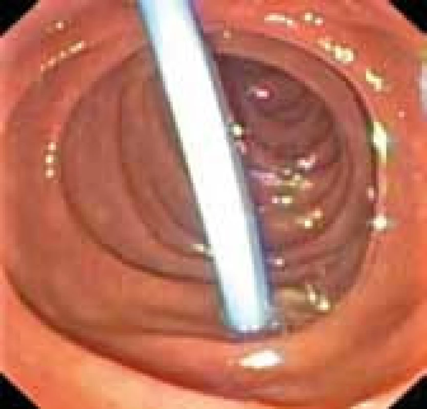 Drenáž žlučových cest perforující duodenum.
Fig. 2. Drainage of the bile ducts perforating the duodenum.