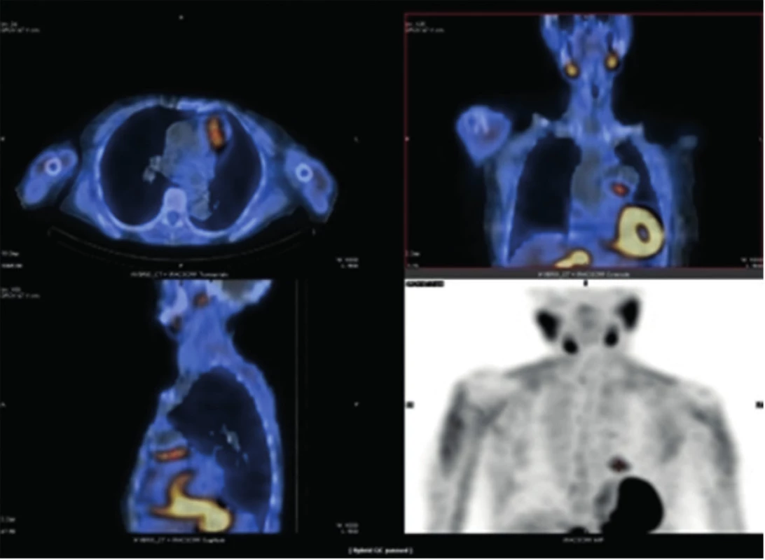 SPECT/CT − kazuistika 1
Fig. 1: SPECT/CT − case report 1