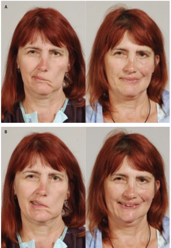 Representative pre- and post- -operative clinical photographs of a patient undergoing mini-invasive temporalis tendon transposition. Frontal views demonstrating facial symmetry and improvement in the position of the nasolabial fold after the procedure: A) closed-mouth smile before and after surgery; B) open- -mouth smile before and after surgery.