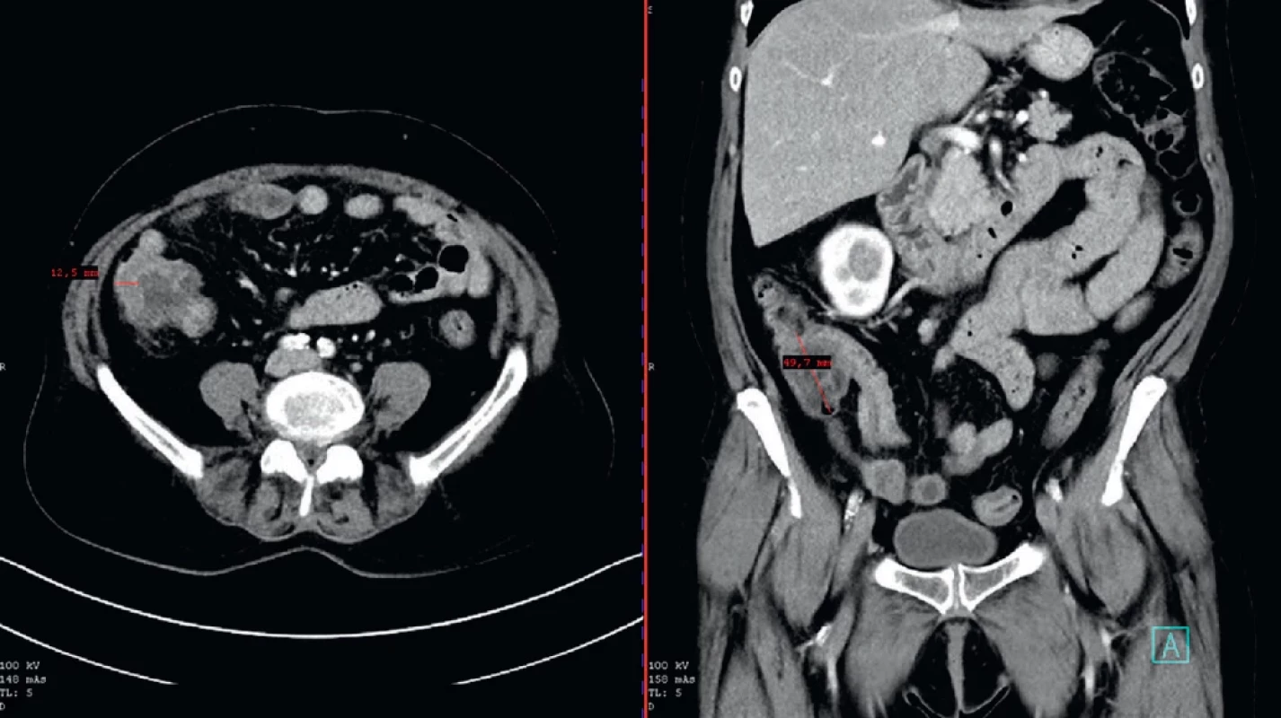 Zesílení stěny céka (transverzální a koronární řez na CT). Wall thickening of the caecum (transvers and coronary CT images).