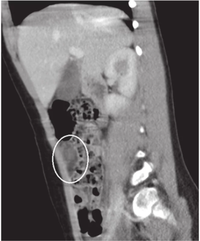 Primární torze omenta - sagitální řez
Fig. 2 Primary omental torsion - sagittal slice