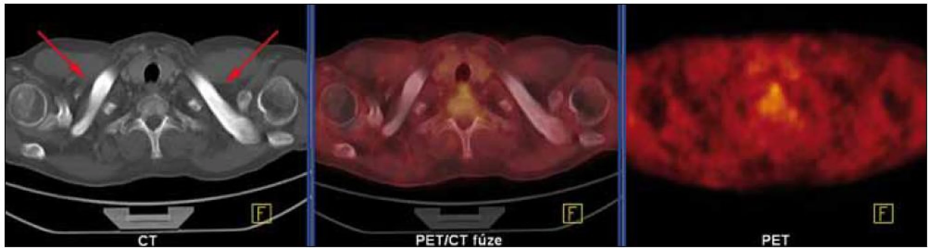 CT komponenta PET/CT vyšetření (září roku 2009) prokázala hyperostotické postižení klíčních kostí bilaterálně. Žádná patologická ložiska hypermetabolizmu glukózy se na PET komponentě nezobrazila.