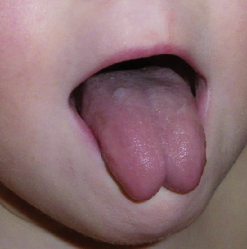 Protruze jazyka pacienta se zkrácenou podjazykovou uzdičkou.
Fig. 1. Protrusion of tongue in a patient with short frenulum.