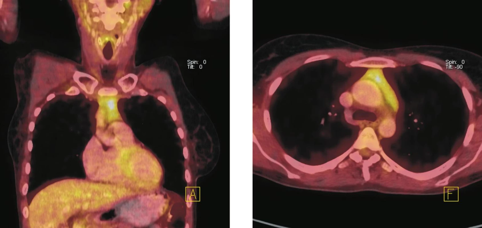 Fúze PET a CT řezů – koronální (vlevo), transverzální (vpravo). Zvýšená akumulace <sup>18</sup>F-FDG v měkkotkáňové struktuře horního předního mediastina, která nebyla patrná při vstupním vyšetření před zahájením imunochemoterapie. Velikost ani charakter popsané struktury se při pozdějším kontrolním vyšetření nezměnily. Nález hodnocen jako aktivace tkáně thymu po chemoterapii.