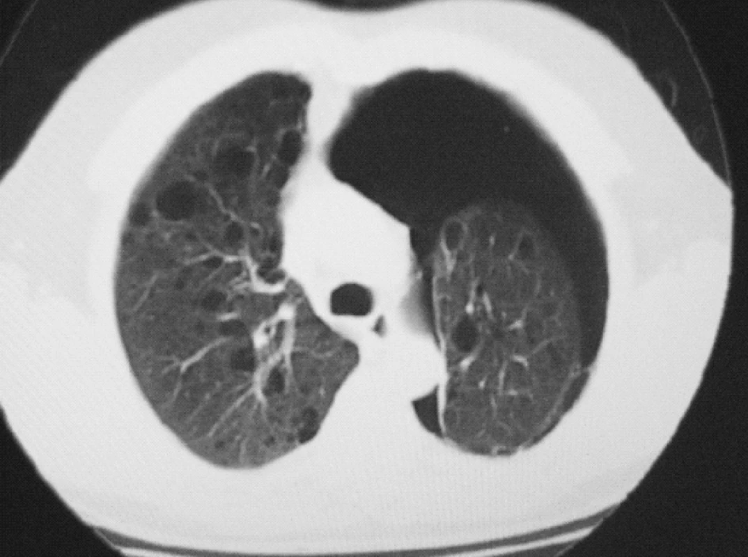 HRCT plic – oboustranný bulózní emfyzém, levostranný PNO
Fig. 3. HRCT lung scan – bilateral bullate emphysema, left – sided PNO