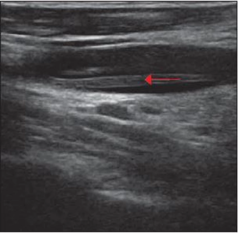 Ultrasonografie, podélná projekce.