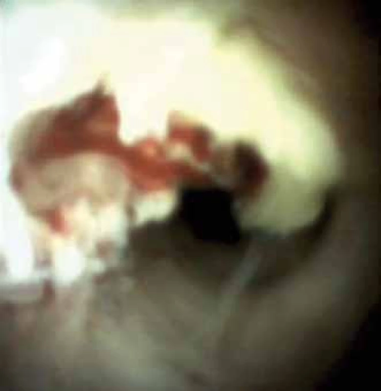 Ulcerace. IgG4 cholangitida.
Fig. 2. Ulceration. IgG4 cholangitis.