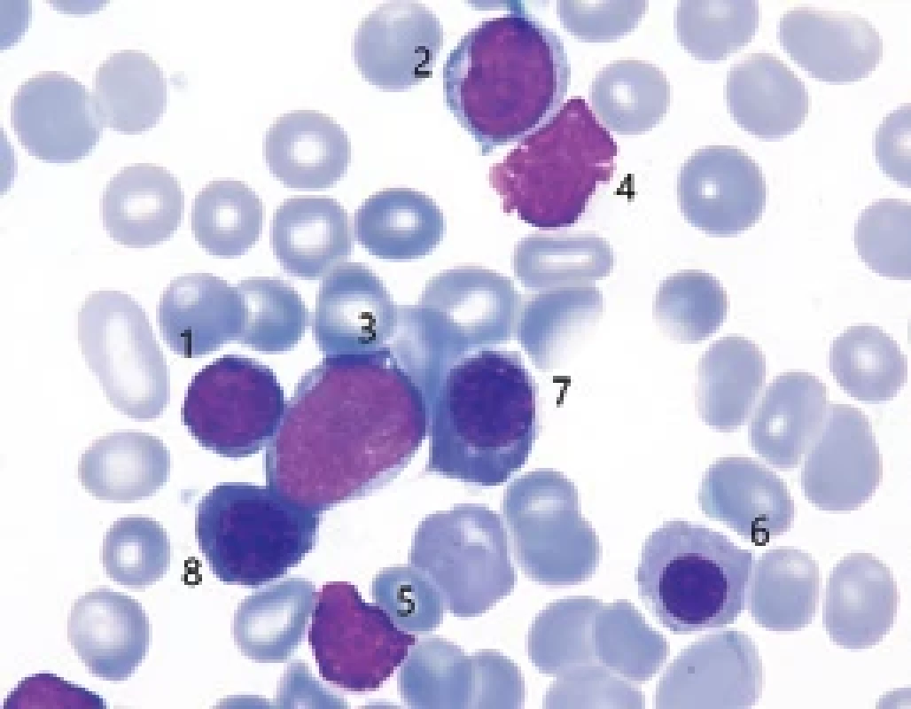 Cytologie kostní dřeně před léčbou: (FNHK, IV. interní hematologická klinika, hematologická laboratoř).
