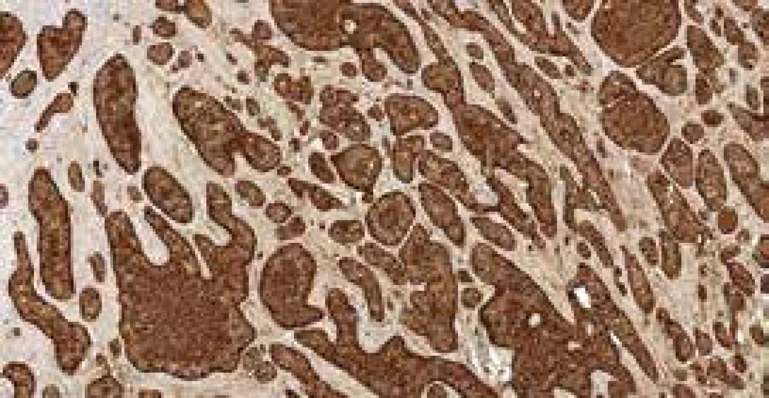 a. Histological section: Solid, insular masses
of monotonous small round cells positive
for chromogranin, immunohistochemical
staining, 200×