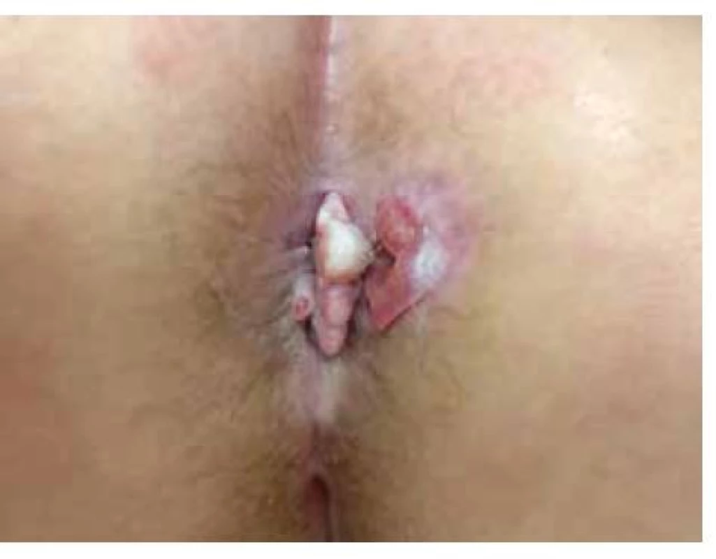 Anální karcinom<br>
(archiv Chirurgické kliniky 2. LF UK a FN Motol)