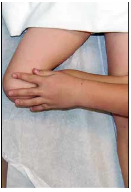 Patrickův test (Faberova zkouška) (FABER = flexe, abdukce a zevní rotace). Dítě je v supinační poloze. Testující osoba provádí flexi, abdukci a zevní rotaci kyčelního kloubu. Bolest v hýždích upozorňuje na patologický nález v SI kloubu. [Zveřejněno s laskavým souhlasem Naranje S, Kelly DM, Sawyer JR. A sys- tematic approach to the evaluation of a limping child. Am Fam Physician. 2015;92(10):914.]