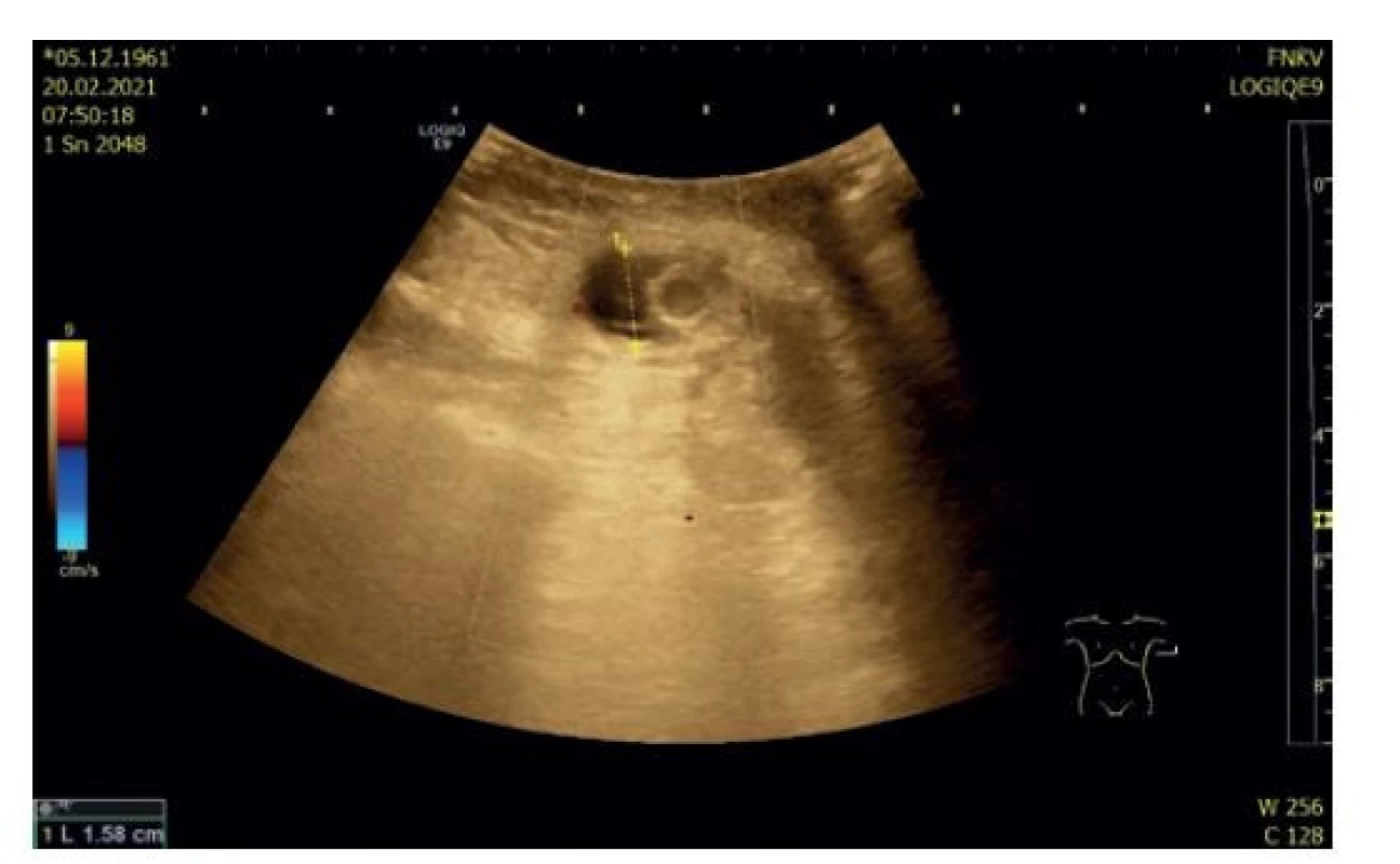 Sonografický nález uskřinuté hernie<br>
Fig. 1: Sonographic finding of incarcerated hernia