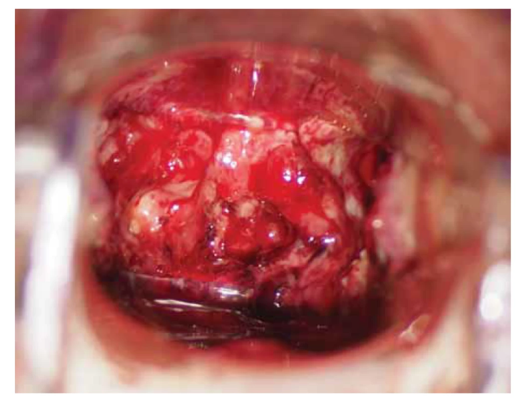 Kolposkopický obraz – 1. měsíc užívaní antituberkulotik.<br>
Fig. 2. Colposcopic examination – 1st month of antituberculosis treatment.