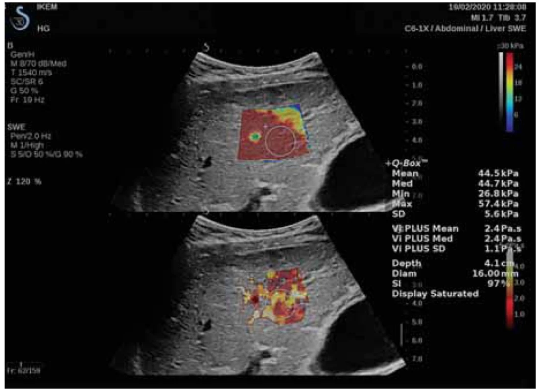 Měření LS pomocí 2D-SWE se zaměřením region of interest a Q boxem.
Laskavě zapůjčila MUDr. Renáta Šenkeříková, IKEM.<br>
Fig. 3. LS measurement using 2D-SWE with focus on region of interest and Q box.
Kindly lent by Renáta Šenkeříková, MD, IKEM.