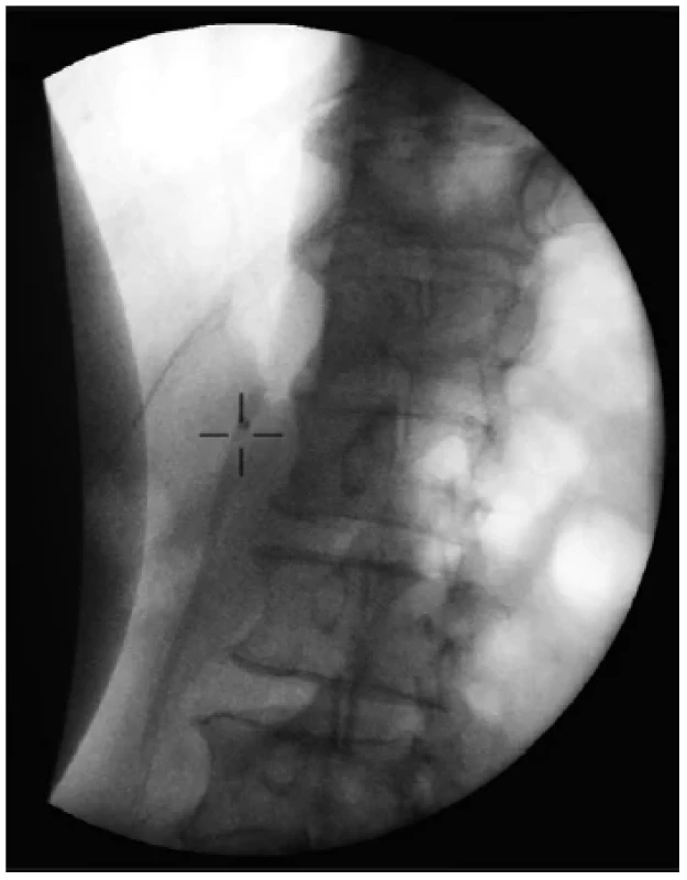 Fluoroscopy image after completing the third session
of extracorporeal shockwave lithotripsy – no signs of
any residual pancreatic duct stone