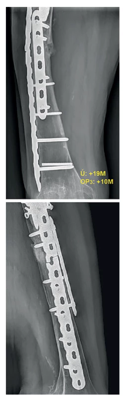 Selhání osteosyntézy 10 měsíců od 2. reoperace<br>
Fig. 6: Implant´s failure 10 months after the 2nd revision
surgery