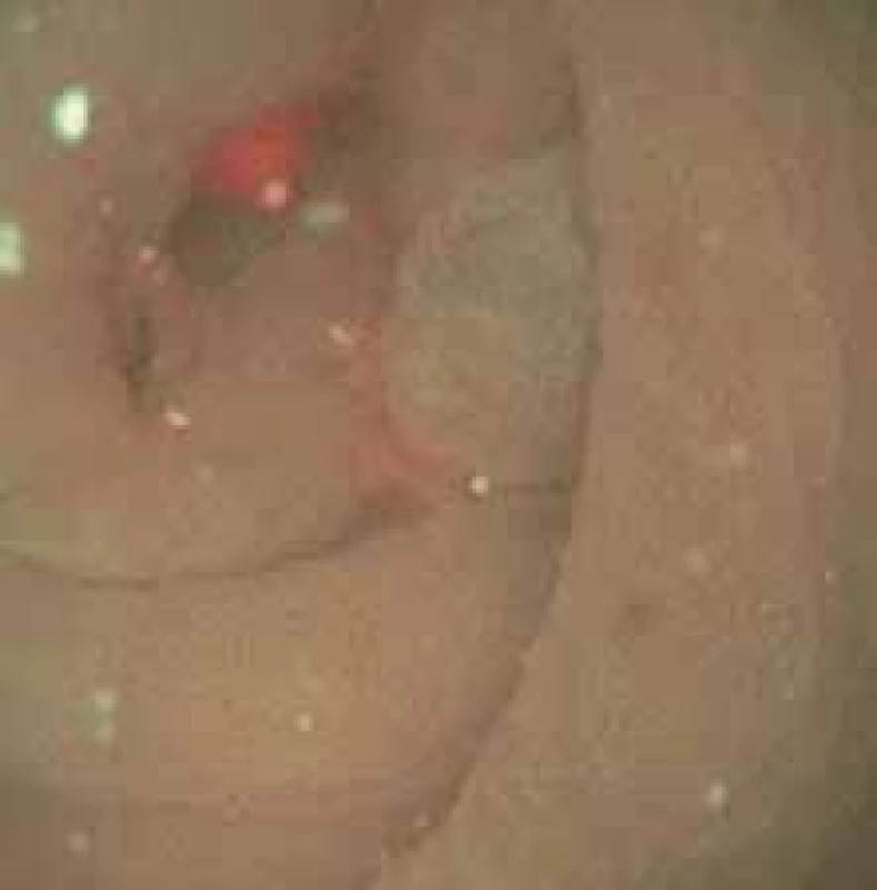 Koloskopický obraz léze dna 
céka při ústí appendixu 0–IIa dle 
Pařížské klasifikace v NBI (Narrow 
Band Imaging).<br>
Fig. 2. Colonoscopic image of the 
cecum bottom lesion at the orifice 
of the appendix 0–IIa according to the 
Paris classification in the NBI (Narrow 
Band Imaging). 