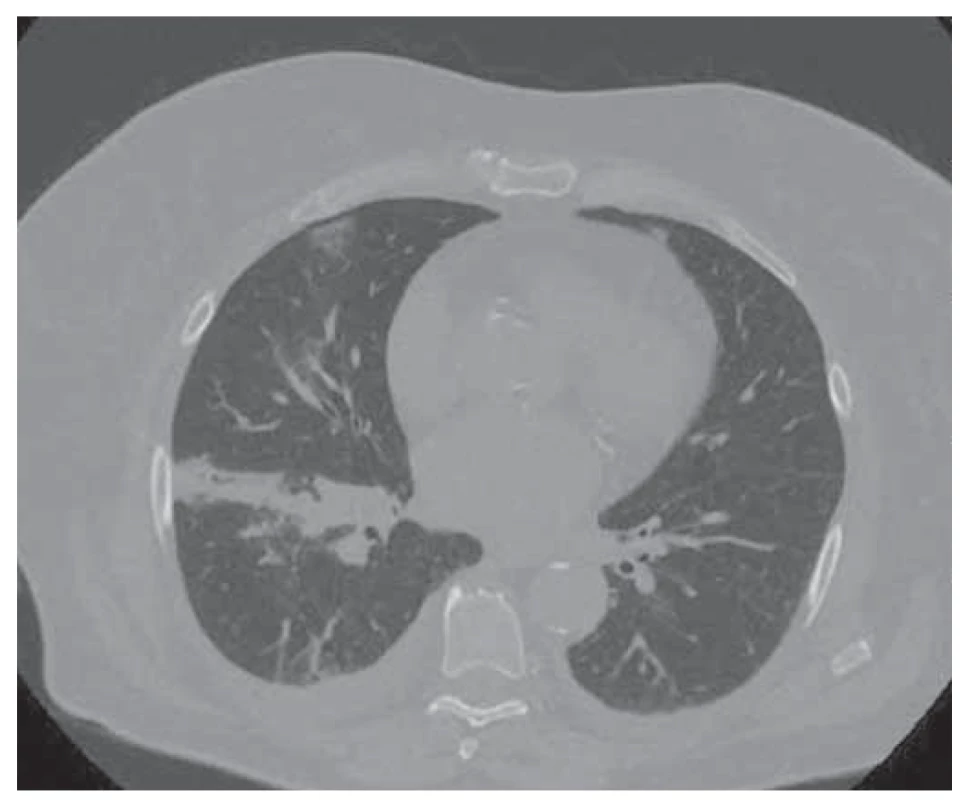 CT – pruhovitá formácia perihilózne vpravo – dystelektáza,
lymfadenopatia mediastina.<br>
Fig. 2. CT – stripe formation perihilously on the right – dystelectasis,
mediastinal lymphadenopathy.