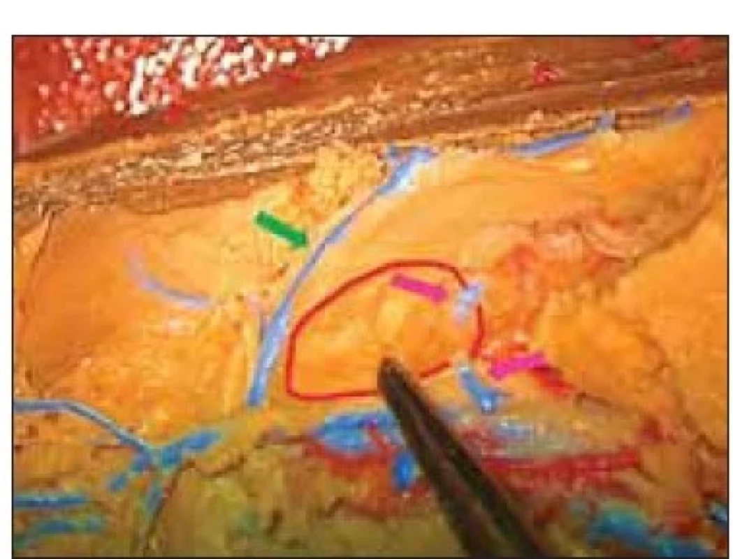 Obraz tuberculum thalami z laterálního
pohledu (označeno pinzetou
a ohraničeno červenou linií). I zde patrny
struktury vena thalamostriata (zelená
šipka) a žilní struktura nacházející se za tuberculum
thalami, vstupuje do žíly drenující
plexus chorioideus (fialové šipky).<br>
Fig. 4 Lateral view of the tuberculum thalami
(marked with forceps and delineated
in red). See the structure of the thalamostriatal
vein (green arrow) and venous
structure located behind the thalamic tuberculum
entering the choroid plexus
draining vein (violet arrows).