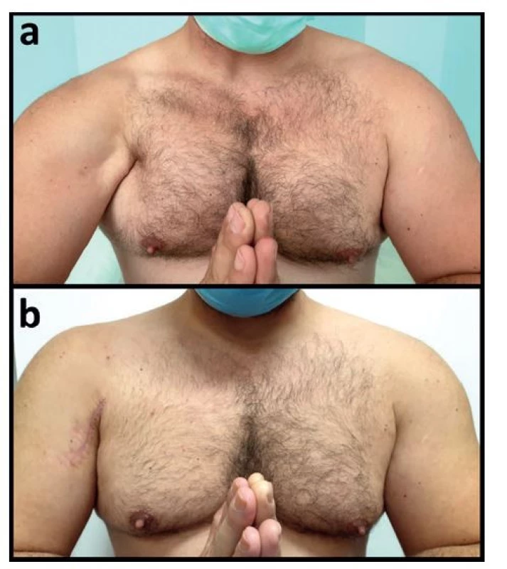 Prayer sign před a po operaci u pacienta s chronickou
kompletní rupturou šlachy m. pectoralis major
vpravo<br>
Fig. 7: Prayer sign before and after operation in a patient
with a chronic complete rupture of the pectoralis major
tendon on the right side
Vysvětlivky: a – klinický obraz