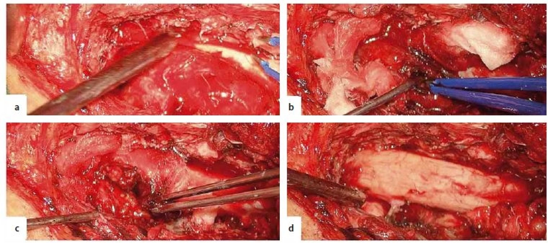 Intraoperative images. A – encapsulated, extramedullary tumour, B – fenestration in the tumour capsule, C – evacuation of an
intracapsular haematoma, D – final aspect with total resection of the tumour.