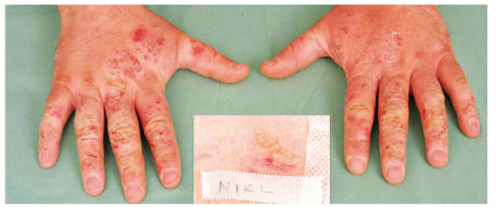Eczema contactum prof. – atopická báze – nikl++ (legovaná ocel) – obráběč kovů
