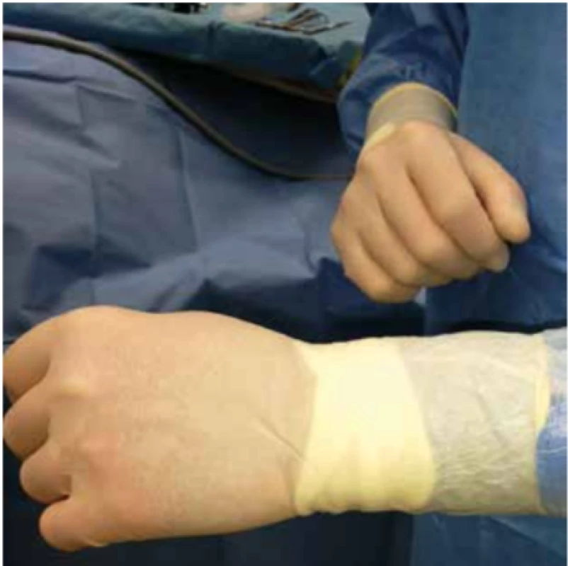 Sterilní folie Steri-Drape 3MTM na předloktí operatéra<br>
Fig. 2: Sterile foil Steri-Drape 3MTM on the the surgeon´s forearm