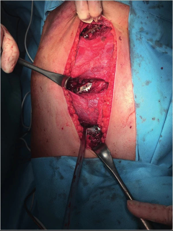 Sparing dissection of muscles for rib splint application, limiting
postoperative soreness