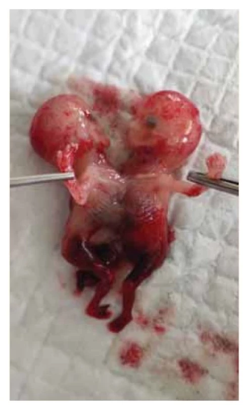 Abortované zrastlice typu thoracopagus,
graviditas hebdomadis
12+5, kompletne fúzované v hrudnej
oblasti (archív II. GPK LF UK
a UN Bratislava).<br>
Fig. 3. Aborted adhesions of the thoracopagus
type, graviditas hebdomadis
12+5, completely fused in the
chest area (archive II. GPK LF UK and
UN Bratislava).